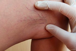 Read more about the article Sclerotherapy: Effective Spider Vein Treatment