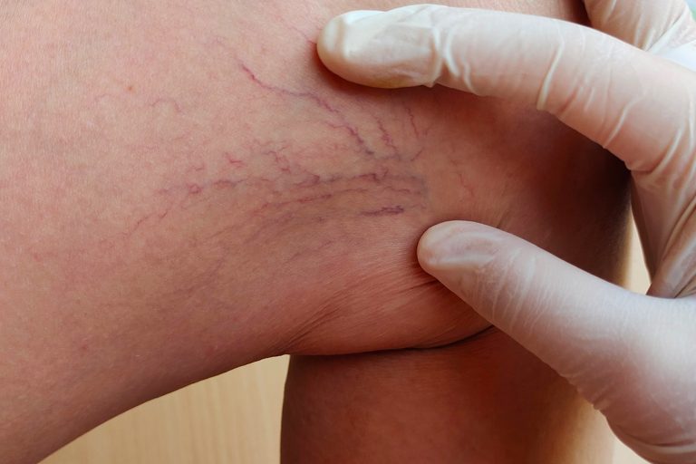 Sclerotherapy: Effective Spider Vein Treatment