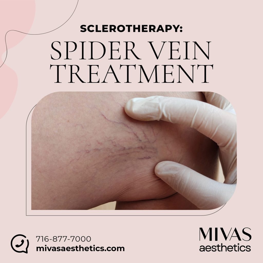 No more hiding your legs under long skirts and pants because you don’t like the look of spider veins.