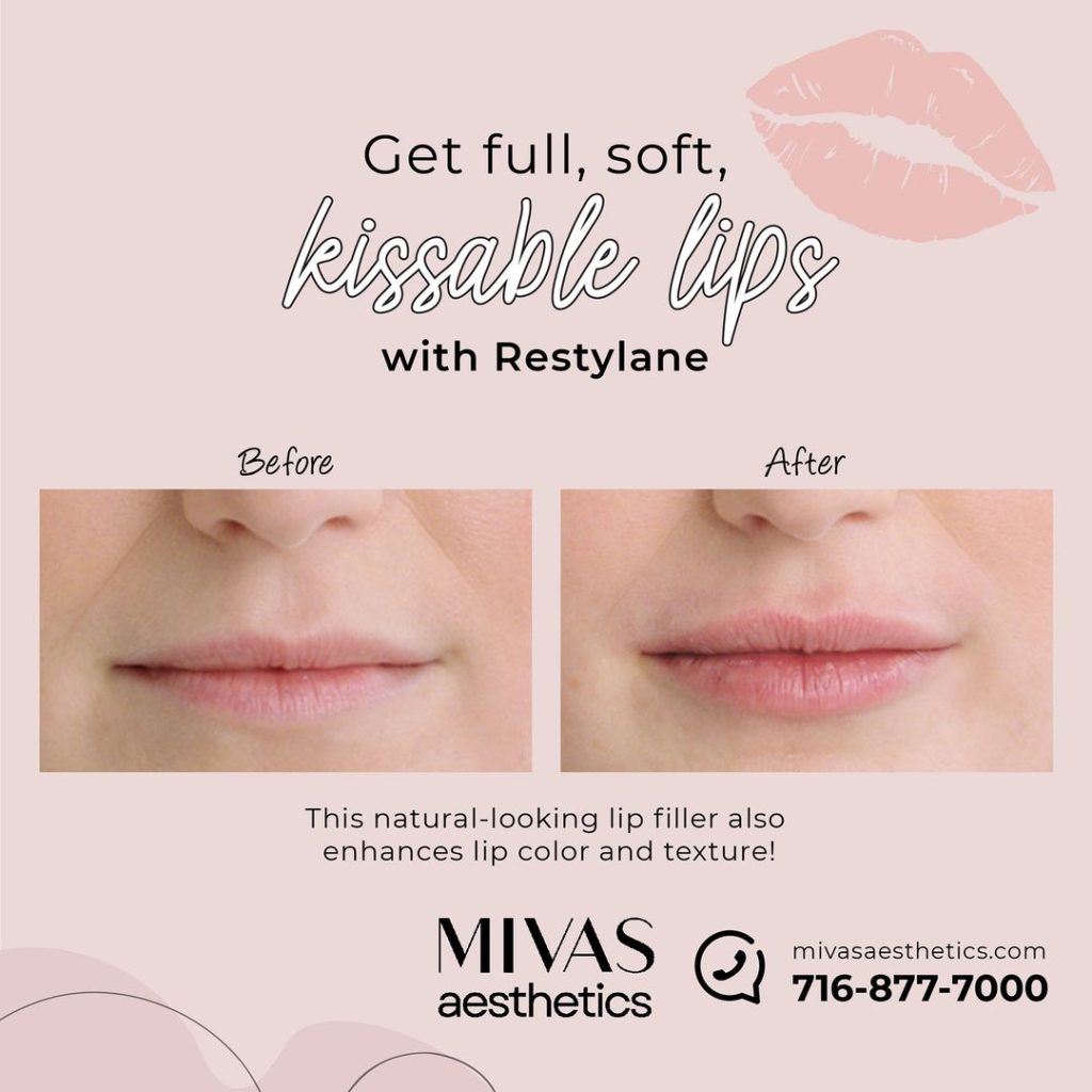 Our lips aren’t sealed…we love Restylane! 👄