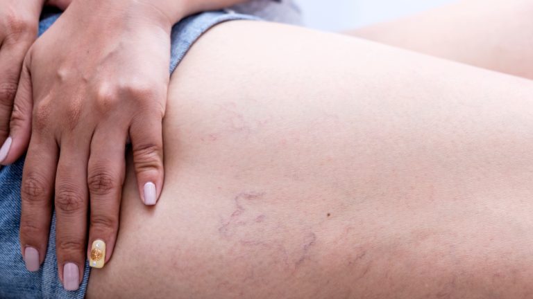 Understanding Spider Veins and Effective Treatment with Sclerotherapy