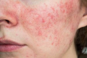 Read more about the article Understanding Rosacea and Its Effective Treatment