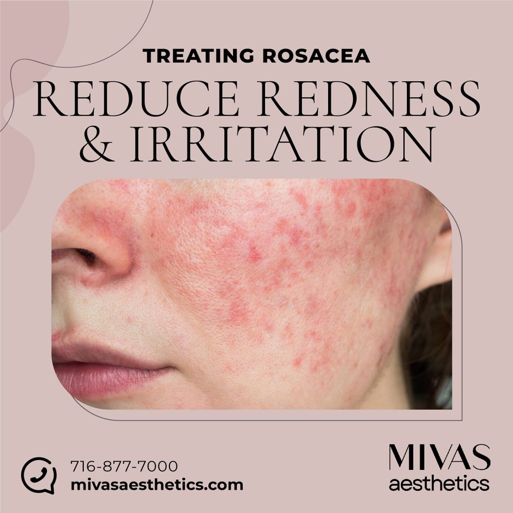 Don’t let rosacea diminish your confidence.