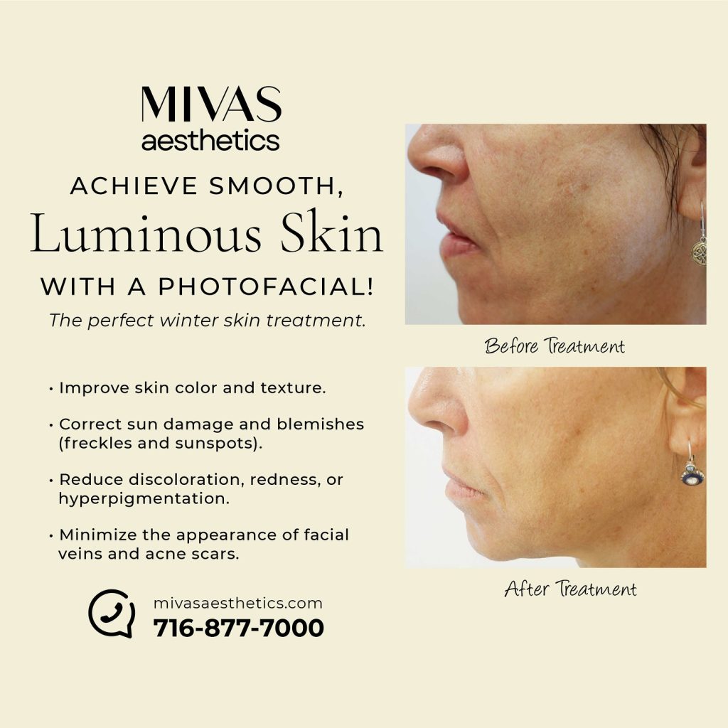 Photofacial =  Luminous Skin