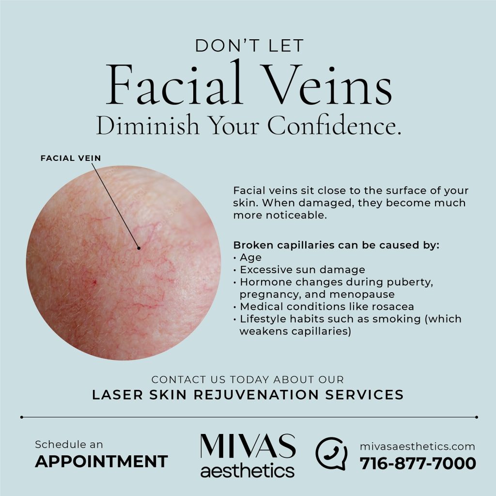 Facial Veins Diminish Your Confidence