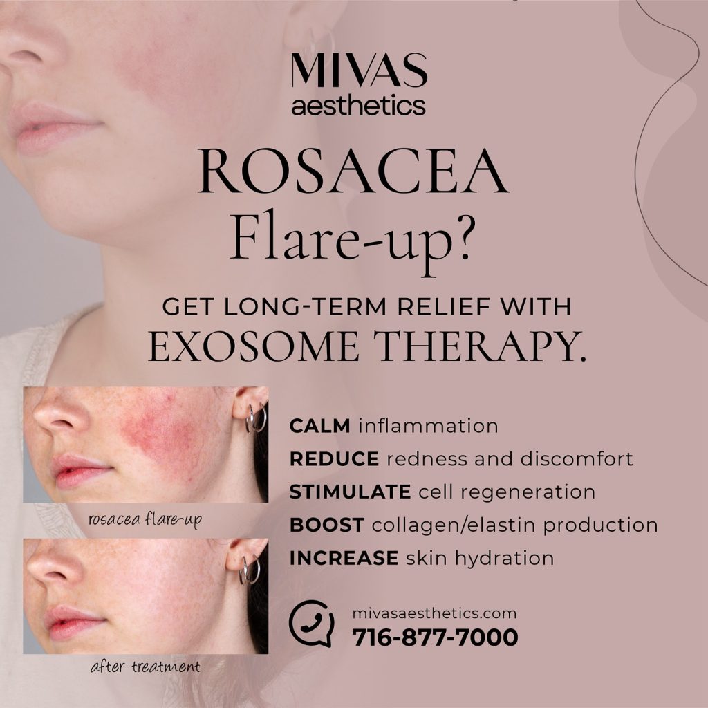 Winter air causing your rosacea to flare-up?