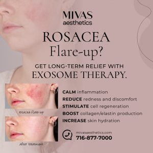 Read more about the article Winter air causing your rosacea to flare-up?