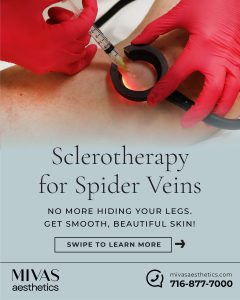 Read more about the article Spider Veins