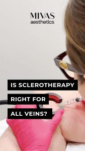 Read more about the article Is Sclerotherapy Right For All Veins
